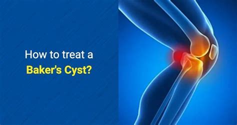 How To Treat A Baker S Cyst Osmo Patch Us