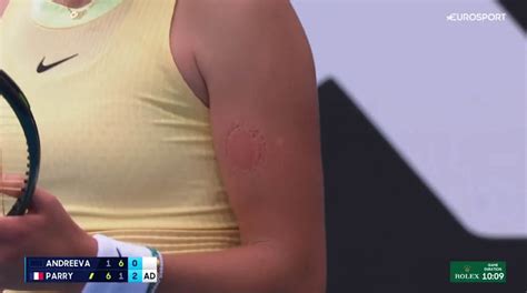 Australian Open Star Mirra Andreeva Shows Off Gruesome Scars After