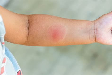 First Aid For Spider Bites Symptoms And Treatment Stc