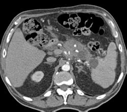 Pancreatic Cancer Encases The Sma And Portal Vein Pancreas Case