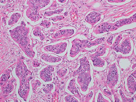 Poorly Differentiated Clusters Pdcs Cancer Cell Clusters Located In Download Scientific