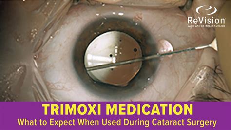 What To Expect When Trimoxi Medication Is Used During Cataract Surgery Youtube