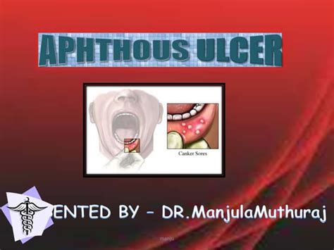 Aphthous Ulcer Ppt