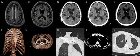 Frontiers Ventriculosternal Shunt For The Treatment Of Idiopathic