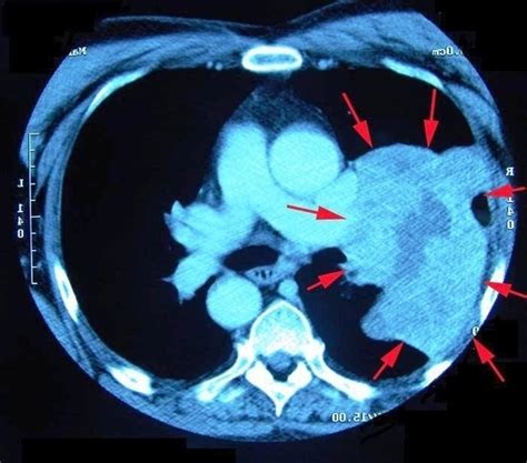 Ct Scan Lung Cancer Image - Graph Diagram