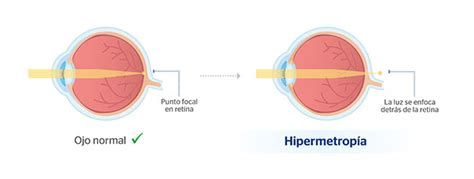 Hipermetropía infantil cómo detectarla a tiempo y curarla Blog de