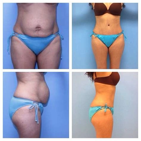 Tummy Tuck Patient Had A Tummy Tuck With Lipo Of Flanks Before And 4 Months After Surgery