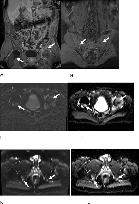 Three Tesla And 3d Multiparametric Combined Imaging Evaluation Of Axial