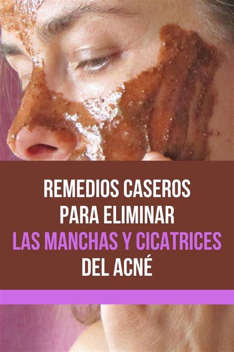 Remedios Caseros Para Eliminar Las Manchas Y Cicatrices Del Acn