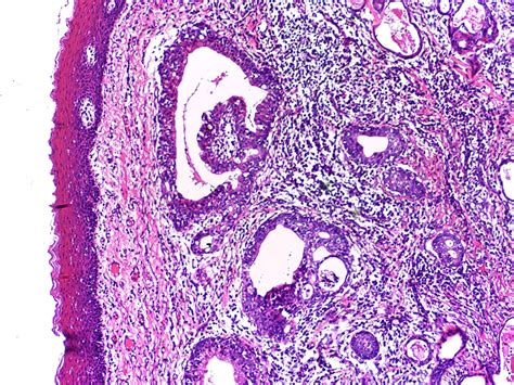 Mucoepidermoid Carcinoma Of The Posterior Lateral Border Of Tongue A Rare Presentation Bmj