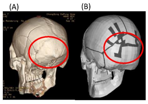 Types Of Skull Fracture