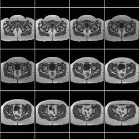 Axial Fast Spin Echo Fse T Weighted Sequence In Pelvic Magnetic