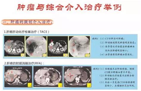 生命通道丨帶您認識肝癌的介入治療，盤點介入治療的優點 每日頭條