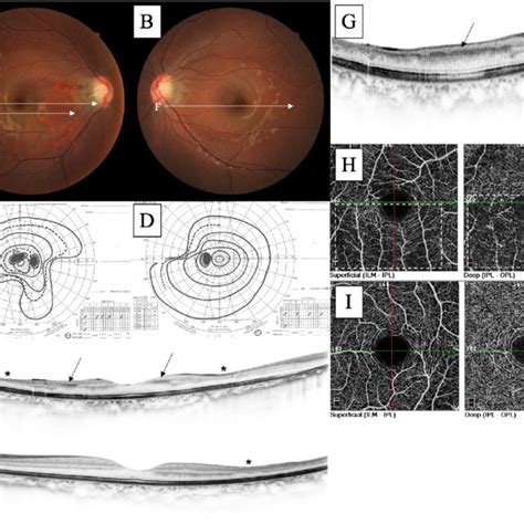 Multimodal Imaging Including Color Fundus Photography And