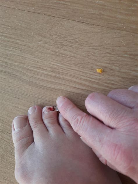 I crushed my toenail and now it's falling off. Ugh.😫 | Scrolller