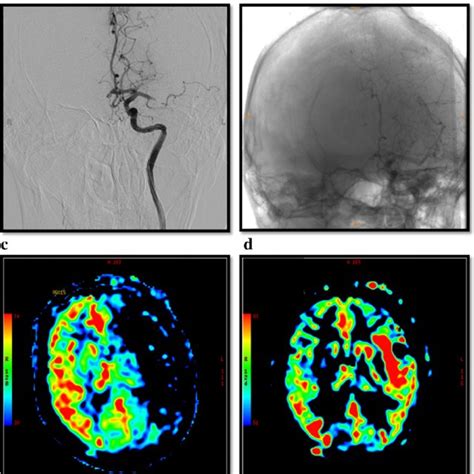 Changes Of Cerebral Blood Flow Pre A C And Post B D Mechanical