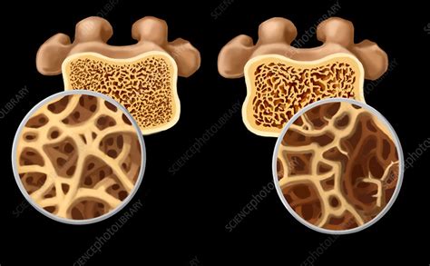 Osteoporosis Illustration Stock Image C027 6255 Science Photo