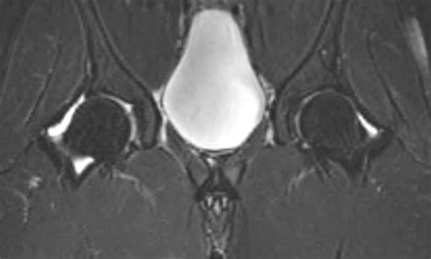 Bone Bruise Knee Mri