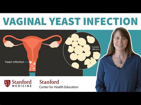 How To Cure Vaginal Yeast Infection Outlet