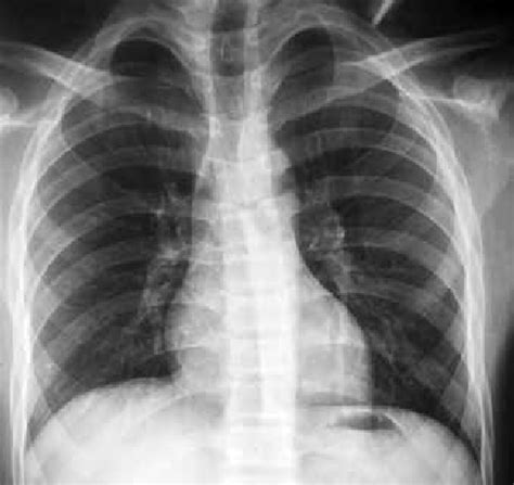 Chest Radiograph Postero Anterior View After Days Of