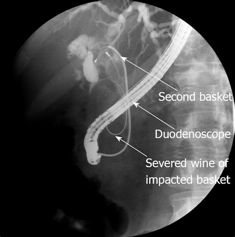 Wire Basket Sweep Ercp Bile Duct