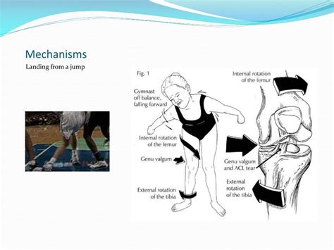 Ppt The Anterior Cruciate Ligament Injury Prevention And Treatment