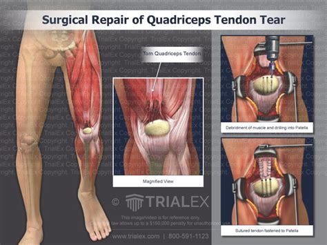 Quadriceps Tendon Repair