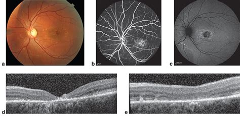 Stargardt Disease American Academy Of Ophthalmology