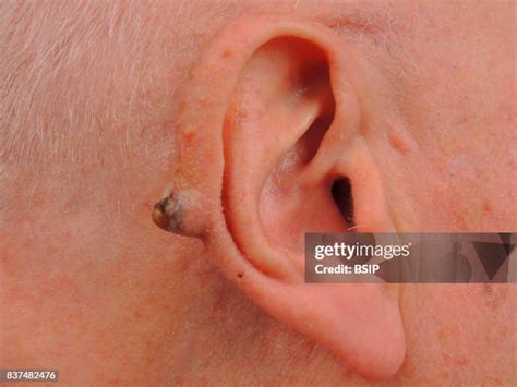 Squamous Cell Carcinoma Photos Foto E Immagini Stock Getty Images