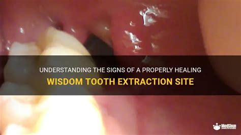 Understanding The Signs Of A Properly Healing Wisdom Tooth Extraction Site Medshun