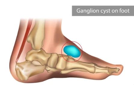 Recovery From Ganglion Cyst Removal On Foot Clearance