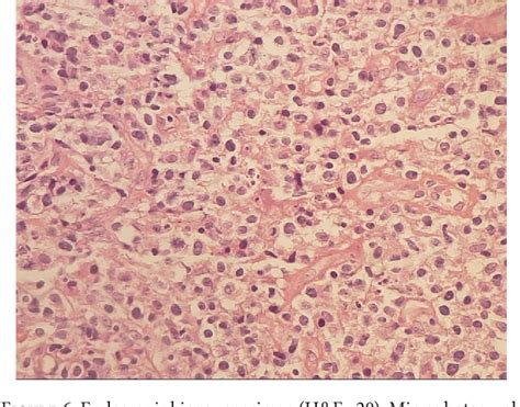 Figure From Orbital Lymphoma Masquerading As Orbital Cellulitis