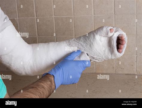 Orthopedic Technician Putting On A Fiberglass Plaster Cast On A Stock