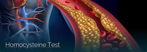 Homocysteine Test Great Plains Laboratory