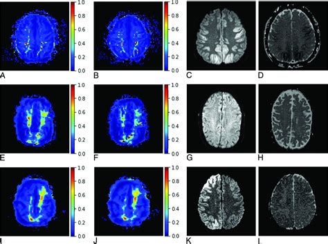 Anoxic Brain Injury Detection With The Normalized Diffusion To Asl Perfusion Ratio Implications