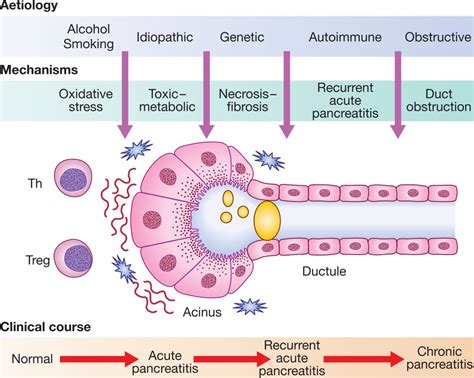 Pancreatitis Cr Nica Gastro M Rida