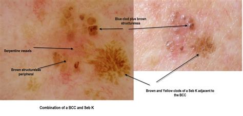 Dermatoscopy Made Simple: Pigmented BCC