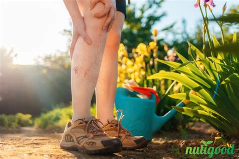 4 Simple Ways To Treat Varicose Veins Nutigood