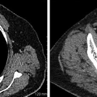 Axial Ct Thorax A With Contrast Showing A Lobulated Cm Soft