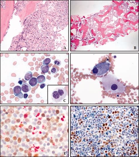 Myeloid Neoplasms With Isolated Isochromosome 17q Represent A