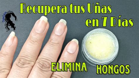 Los Mejores Aceites Para Tratar Los Hongos De Las Uñas