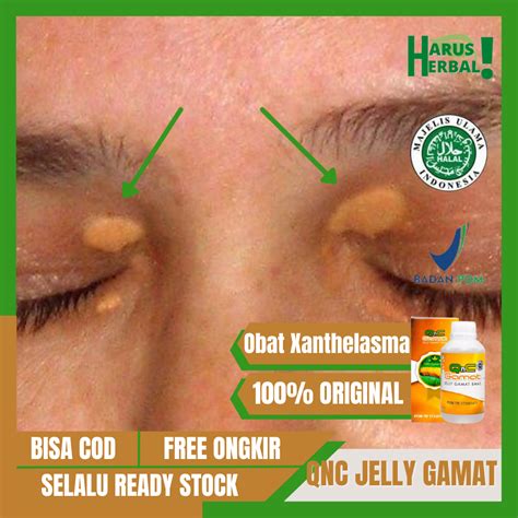 Obat Xanthelasma Obat Menghilangkan Lemak Di Kelopak Mata Obat Oles