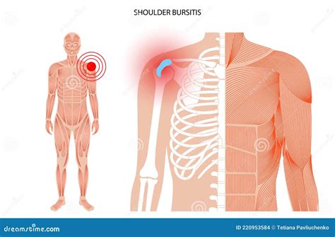 Bursitis Inflamación Concepto Ilustración del Vector Ilustración de