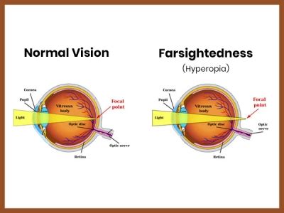 What Is Hyperopia Farsightedness Symptoms Causes Diagnosis