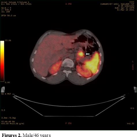 Figure From Evaluation Of The Efficacy Of Ga Dotatate Pet Ct In