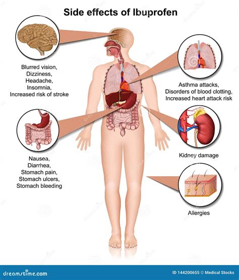 Side Effects of Ibuprofen 3d Medical Illustration on White Background ...