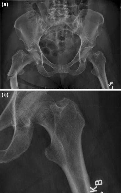 A Anteroposterior Pelvis Radiograph Of A Sixty Three Year Old Female