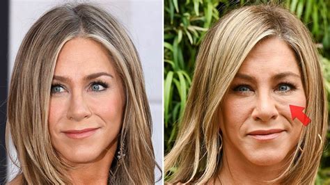 Surgeon Says Jennifer Aniston S Aged Face Is From Botched Filler In