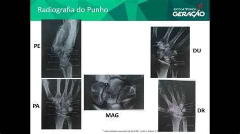 Radiografias Do Punho YouTube