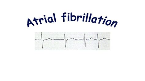 Atrial Fibrillation Youtube